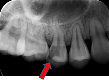 術前：歯髄にまで及んだ深い虫歯