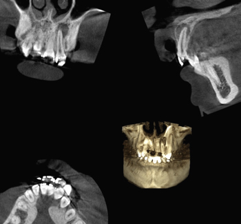 歯科用CTによる　3次元の精密診断