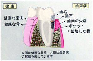 歯周病とは